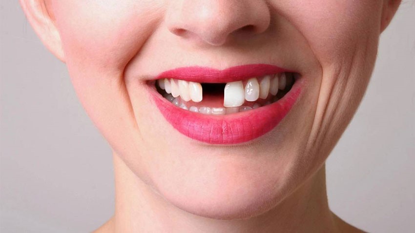 چرا استفاده از دندان مصنوعی در بین جوانان رایج شده است؟